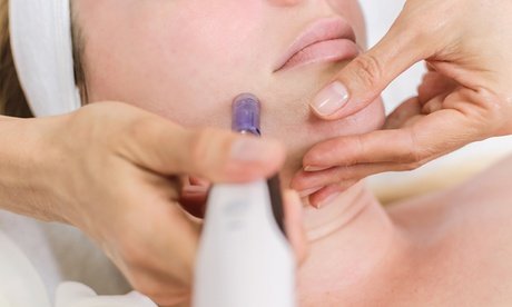 2x 90 Min. Microneedling-Behandlung für das Gesicht für 2 Personen