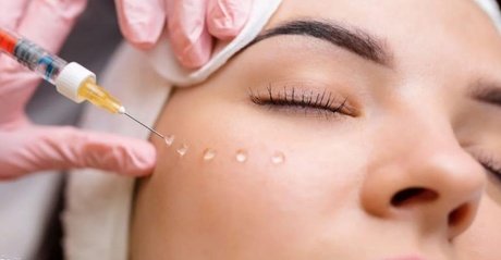 Lippenunterspritzung mit 0 5 ml Hyaluron für 1 Person