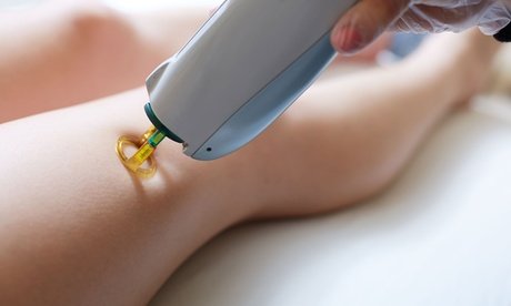 1x Diodenlaser Behandlung Ganzkörper