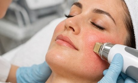 Microneedling wahlweise Gesicht Hals oder Dekolette