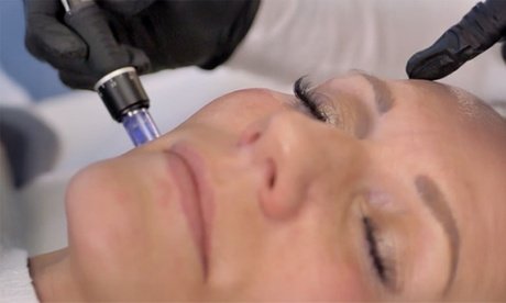 1x Mesotherapie inkl. Microneedling für 1 Person