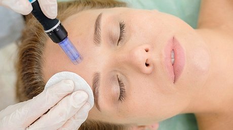 1x Microneedling Behandlung inklusive Abschlusspflege
