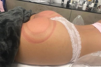 1 Popo-Lift-Vakuum-Behandlung