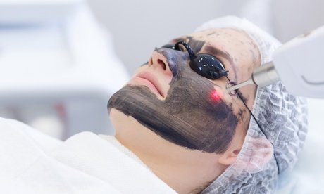 1x 50 Min. Carbon-Laser-Peeling mit Hyaluron-Ampulle für 1 Person