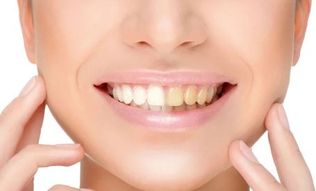 30 Min. kosmetisches Zahn-Bleaching inkl. Beratung