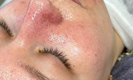 1x Microneedling-Behandlung mit Wirkstoffampulle für 1 Person