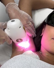 Für Männer: 3 x Laser Haarentfernung an kleiner Zone