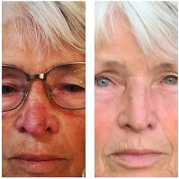 100 € Wertgutschein anrechenbar auf eine Behandlung ab 300€