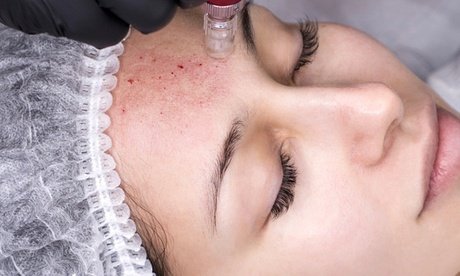 Microneedling inkl. Hyaluron und Maske für 1 Person