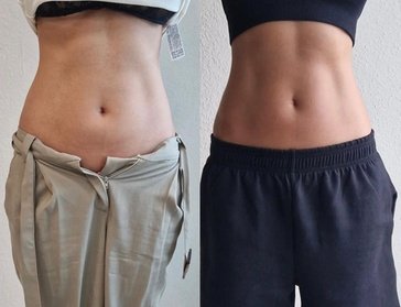1x 30 Min EMS Bodysculpting mit Radiofrequenz inkl. Beratungsgespräch