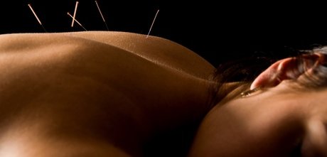 2x 25 Min.Akupunktur inkl. 20 Min. Erstgespräch für 1 Person