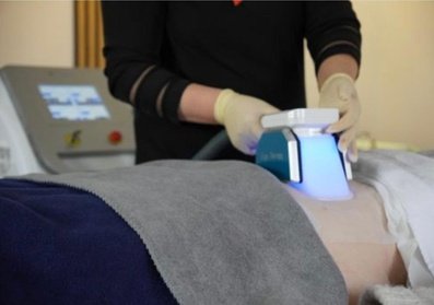 1x 60 Min. Kryolipolyse-Behandlung an 1 Zone nach Wahl inkl. Beratungsgespräch