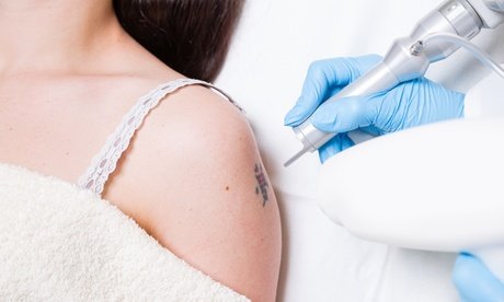 Wertgutschein über 100 € anrechenbar auf eine Tattoo-Entfernung