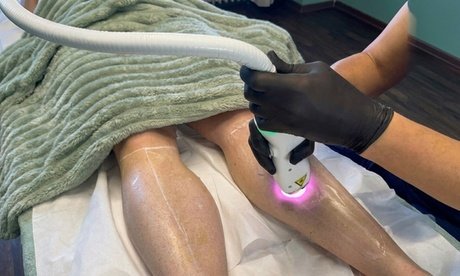 2x Dioden-Laser-Haarentfernungen an den Achseln für 1 Person