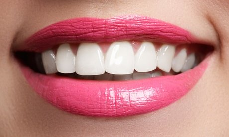 Zahn-Bleaching Classic (45 Min.)