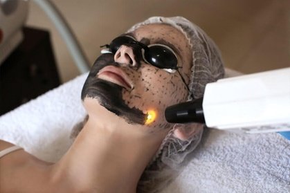 Für Gesicht und Hals: 60 Min. Carbon-Peeling (Hollywood-Peeling) für 1 Person