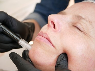 3x 60 Min. Microneedling