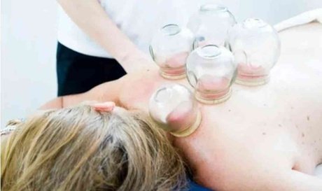 Eine Schröpfen-Sitzung