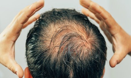 60 Min. Mesotherapie für den ganzen Kopf (Haarausfall) für 1 Person