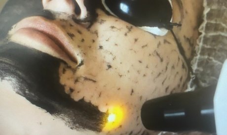 2x 60 Min. Carbon-Laser-Peeling mit Hyaluron- & Intensivpflege-Ampulle für 1 Person