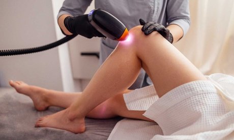 3x Langanhaltende Haarentfernung an kleiner Zone mit BlueICE 3W-Laser