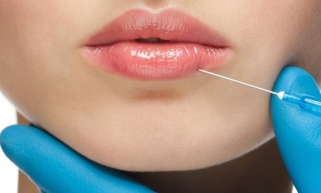 Behandlung mit 0 5 ml Hyaluronsäure an Zone nach Wahl