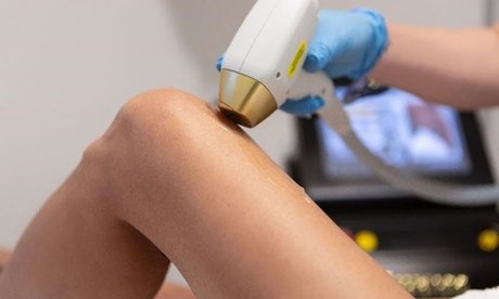 Am Ganzkörper (für Damen): 1 x Laser-Haarentfernung für 1 Person