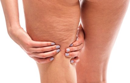 Anti-Cellulite-Microneedling am Bauch für 1 Person