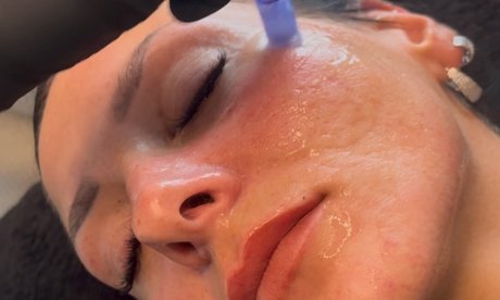 1x Microneedling inkl. Hyaluronsäure Maske und Abschlusspflege