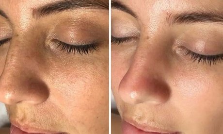 Signature Hydrogen-Behandlung: Tiefenreinigung & Feuchtigkeit für 1 Person