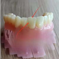 Resin Dentistry Temporary dental TEMPORARY CROWN 3D Printing A2 A1color High toughness strength UV photosensitive Photocuring