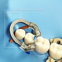 1PC Transparent Head Dental NiTi Clamp Ring | Powerful Separation | Secure, Collapse-Resistant Dentistry Matrix System