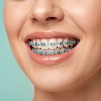 Cosplay Daily Wear Temporary Tooth Braces Colorful Metal Bracket Fashion Dental Decoration Ties 1 Pair CK1160