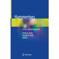 Hammertoes