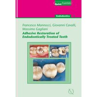 Adhesive Restoration of Endodontically Treated Teeth