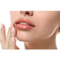 Dermal Filler – Lips, Cheeks, Marionette Lines or Nasolabial Folds
