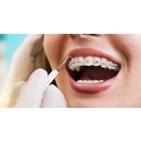 Tooth-Coloured Clear Braces at Dental Care London