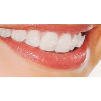 Orthodontic Braces at VidaDent