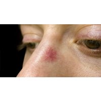 Laser Thread Vein Removal