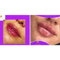 Up to 2ml Dermal Filler Packages for Beautifully Enhanced Features