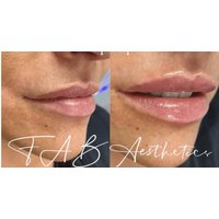 0.5ml or 1ml Dermal Filler at Fab Clinic (Up to 62% Off)