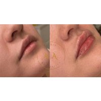 Revitalize with 0.5 or 1 ML Dermal Filler for Lips