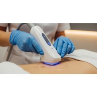Radio Frequency for Skin Tightening and Cavitation for Fat Reduction