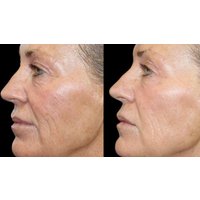 Morpheus8 Non-surgical Tightening - AdvaTx Laser Clinic