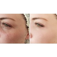 Aqualyx Fat Dissolving Treatments for Targeted Body Contouring