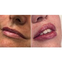 Enhance Your Look with Dermal Filler For Lips
