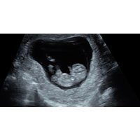 Early Pregnancy Scan or Fetal Health 4D Scan with Scan Movie, & Prints