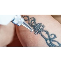 Up to 79% Off on Tattoo Removal at Rethink Me