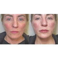 Glow with Dermal Filler (Lips/Cheeks/Chin/Neck) for 1, 2 or 3 ML