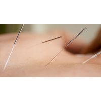 Acupuncture or Cupping and Treatments in EC2M – Save up to 85%